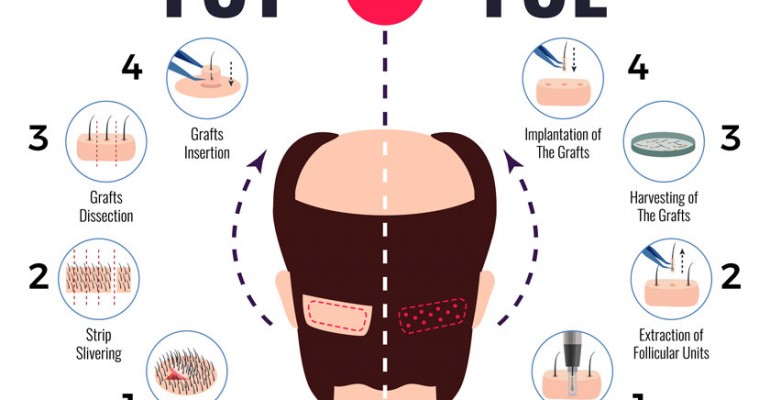FUE tekniği ve tarihçesi